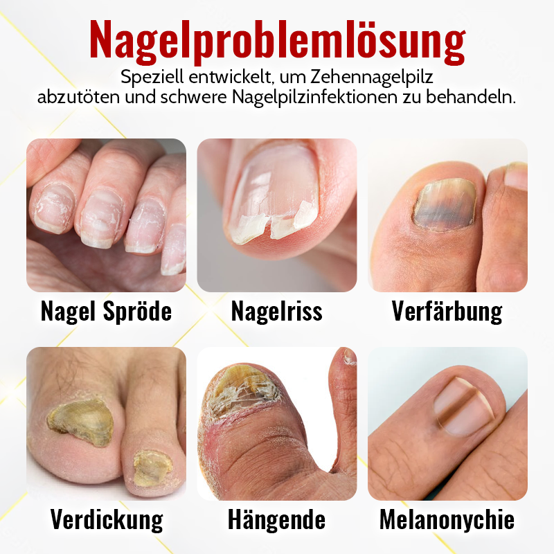 1+1 Gratis | NailSaver™ Onychomycose Rapid Relief Oil 